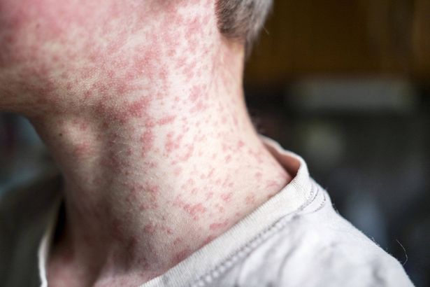 Measles Deaths and an 883-Case Surge: Inside England's Vaccination Crisis
